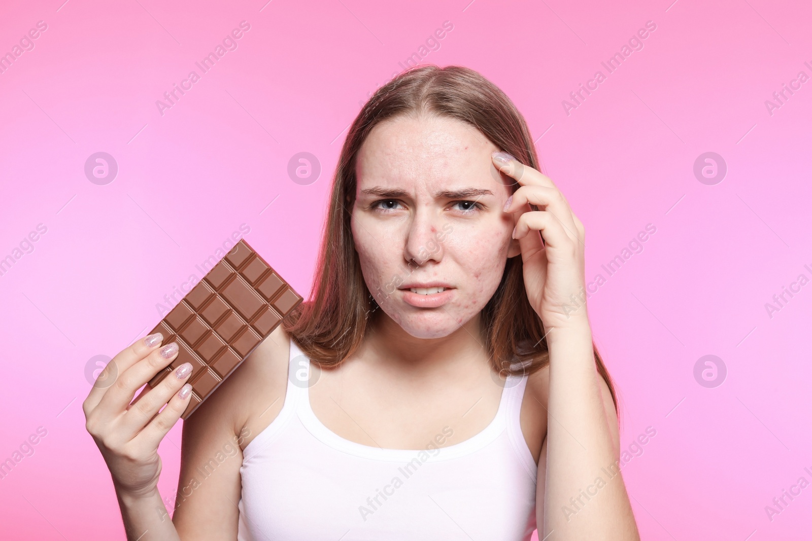 Photo of Young woman with acne problem holding chocolate bar on color background. Skin allergy