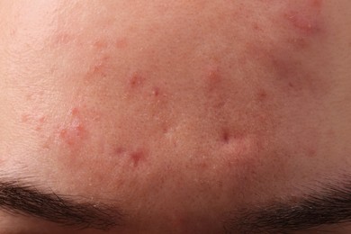 Young man with acne problem, closeup view of forehead