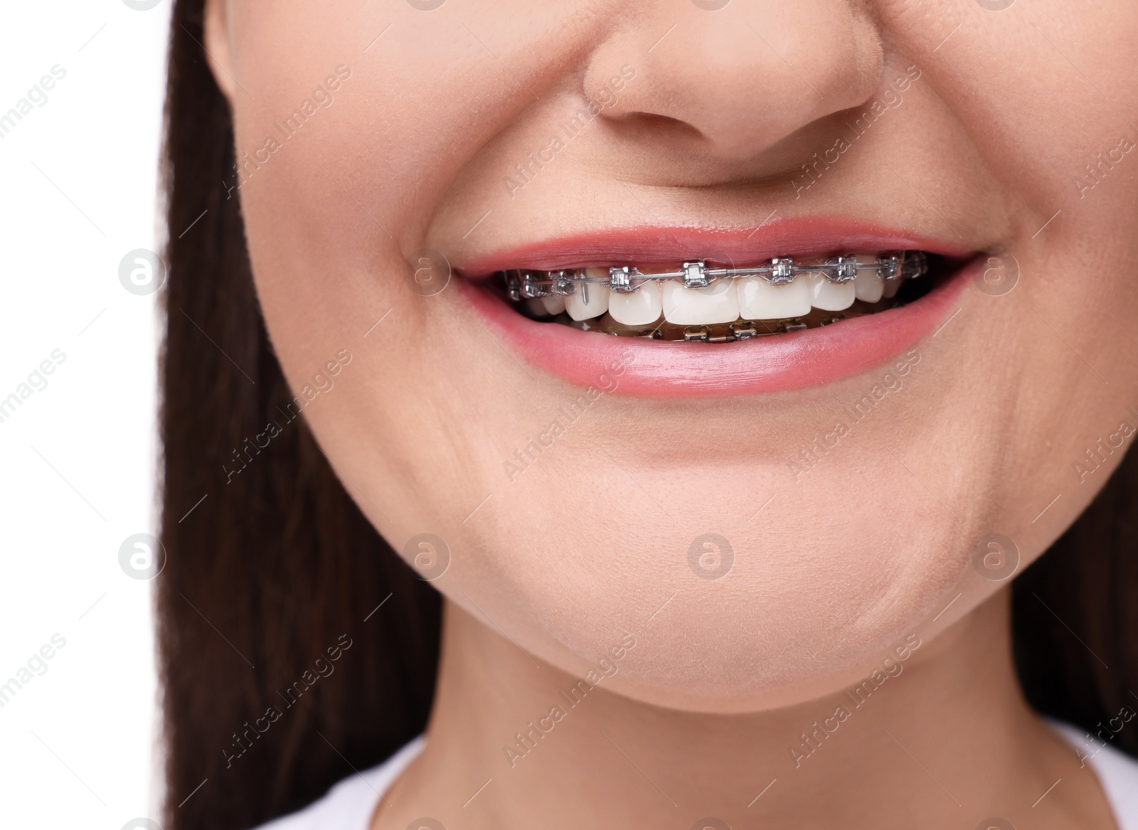 Photo of Smiling woman with dental braces on white background, closeup