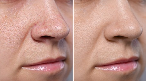 Image of Blackhead treatment, before and after. Collage with photos of woman, closeup view