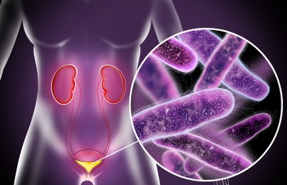 Illustration of Illustration of woman suffering from cystitis. Urinary infection
