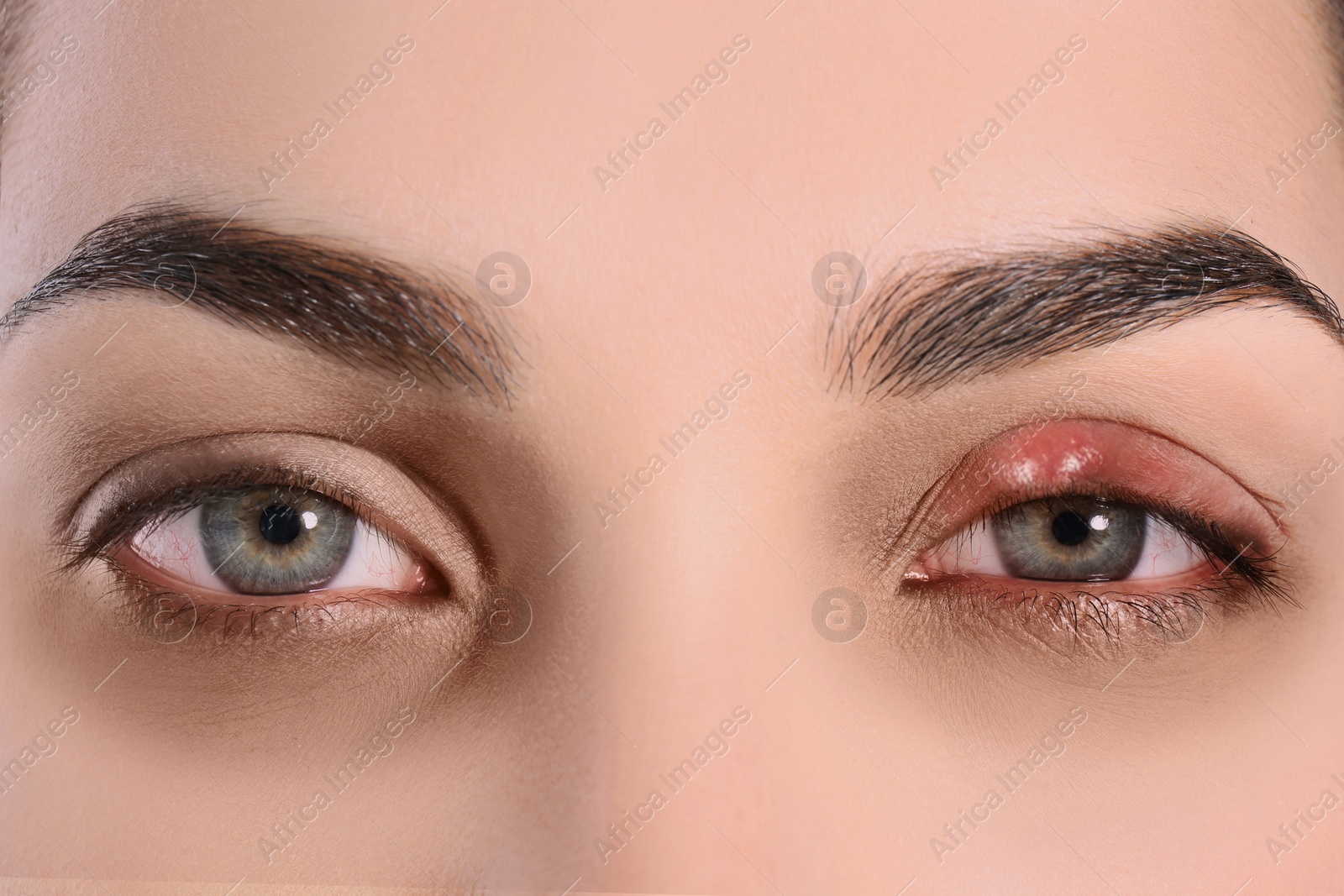 Image of Woman with inflamed eye suffering from conjunctivitis, closeup