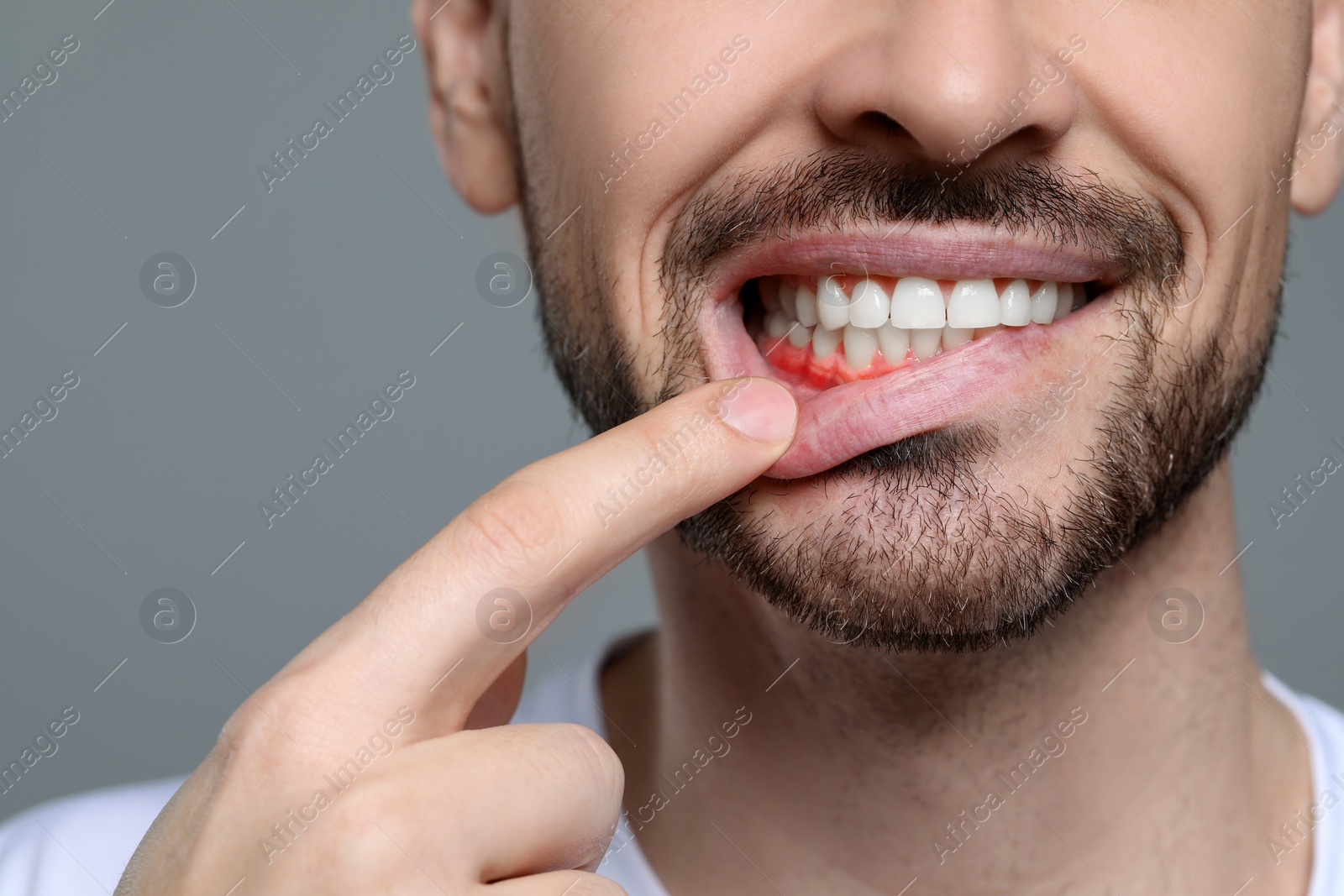 Image of Man showing inflamed gum on grey background, closeup