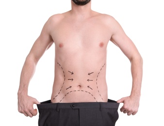 Photo of Young man with marks on belly for cosmetic surgery operation on white background