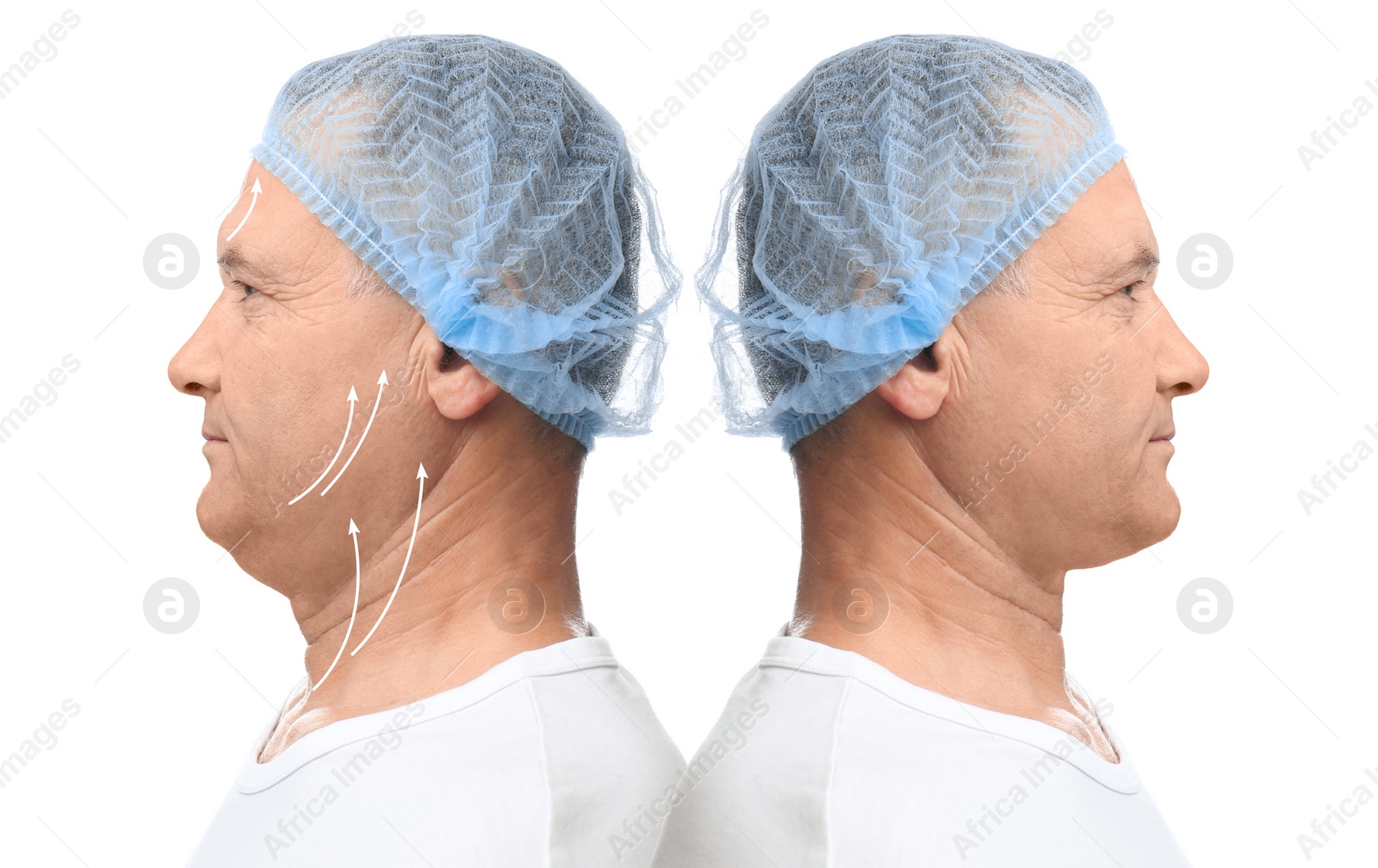 Image of Mature man before and after plastic surgery operation on white background. Double chin problem 