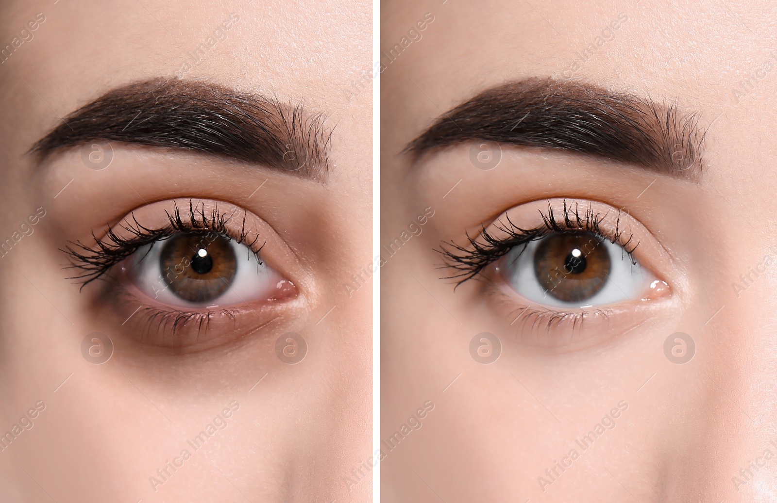 Image of Collage with photos of tired woman with dark circle under eye and after rest, closeup