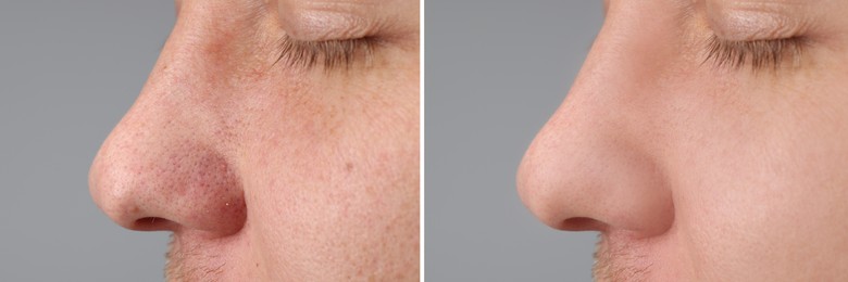 Image of Before and after acne treatment. Photos of man on grey background, closeup. Collage showing affected and healthy skin