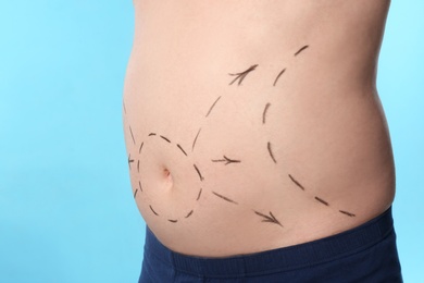 Photo of Man with marks on belly for cosmetic surgery operation against blue background, closeup