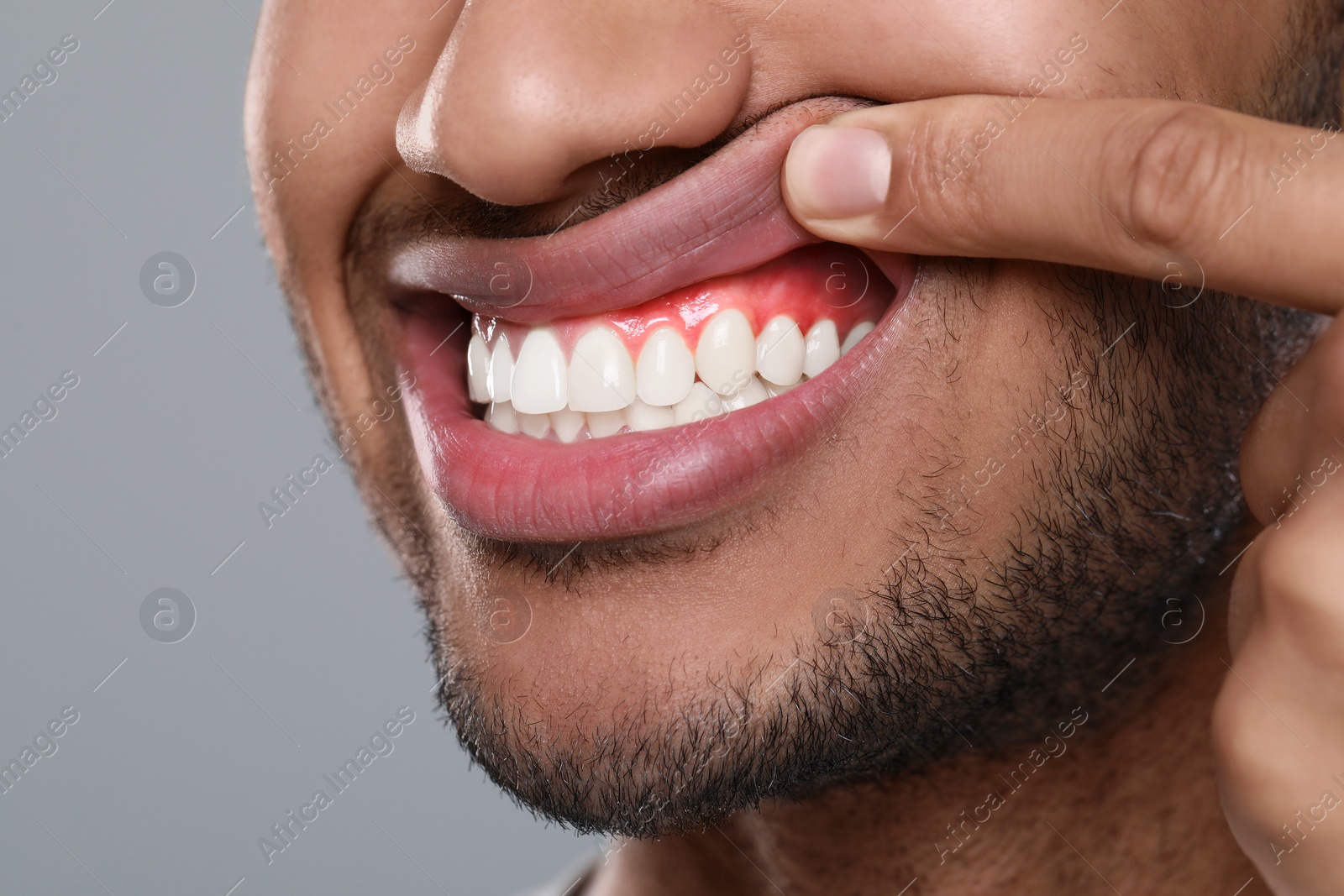 Image of Man showing inflamed gum on grey background, closeup