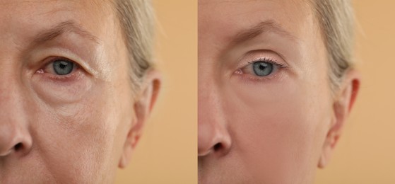 Aging skin changes. Woman showing face before and after rejuvenation, closeup. Collage comparing skin condition