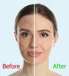 Image of Young woman before and after cosmetic procedure on light background