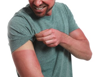 Man with sunburned skin on white background, closeup