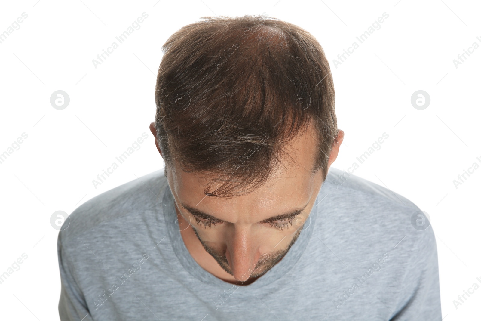 Photo of Man with hair loss problem isolated on white, above view