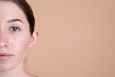 Photo of Young woman with acne problem on beige background. Space for text