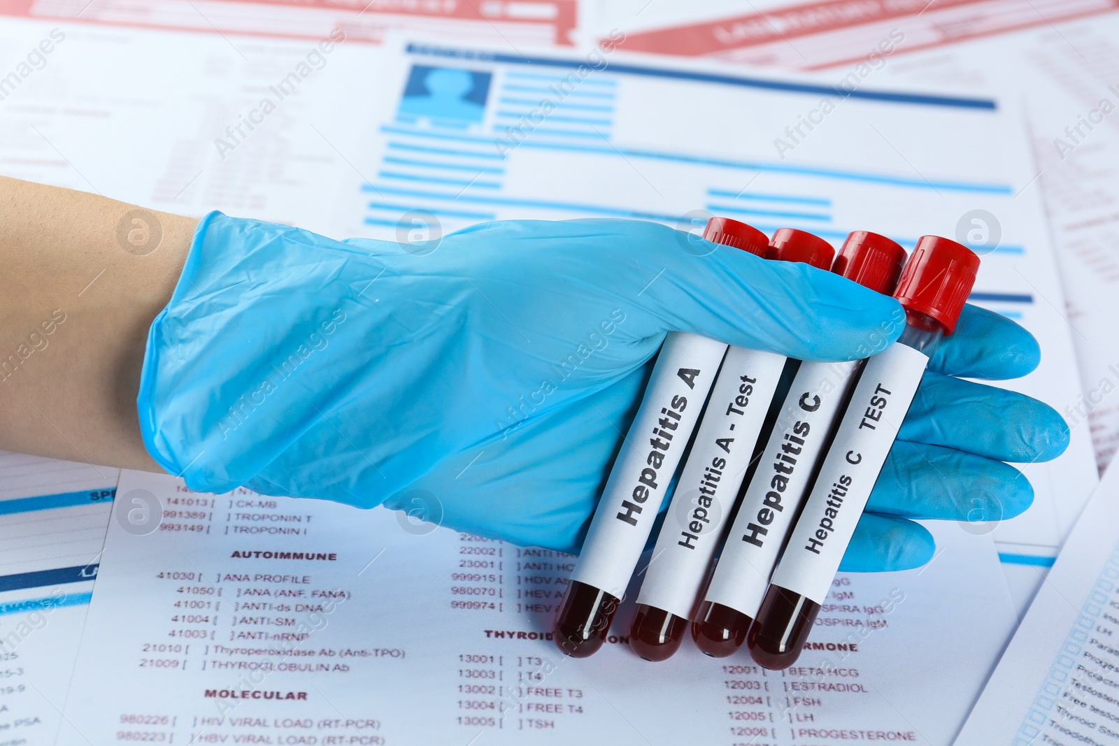 Photo of Scientist holding tubes with blood samples for hepatitis virus test against laboratory forms, closeup