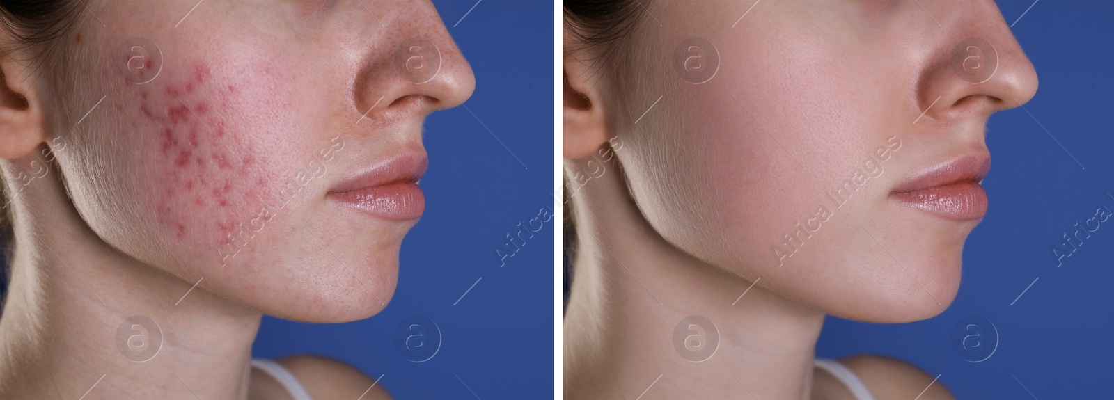 Image of Acne problem. Young woman before and after treatment on blue background, closeup. Collage of photos