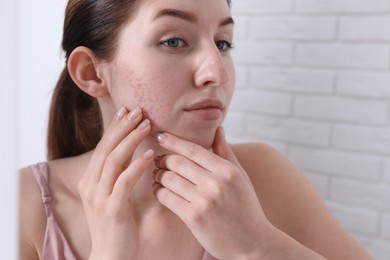 Woman with acne problem near mirror indoors