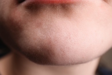 Woman with dry skin on chin, closeup