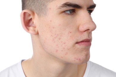 Young man with acne problem isolated on white, closeup