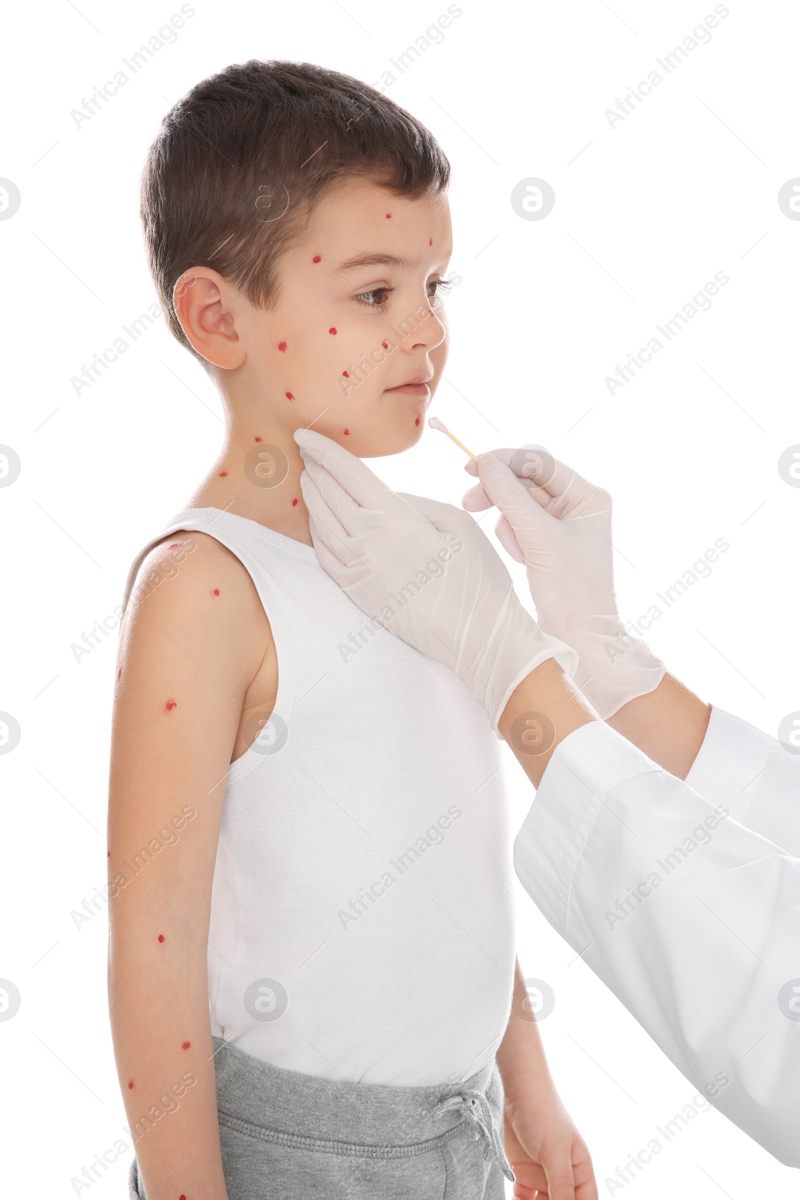 Photo of Doctor applying cream onto skin of little boy with chickenpox on white background. Varicella zoster virus