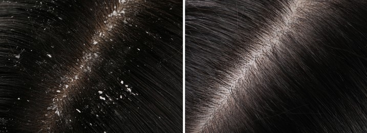 Woman showing hair before and after dandruff treatment, collage