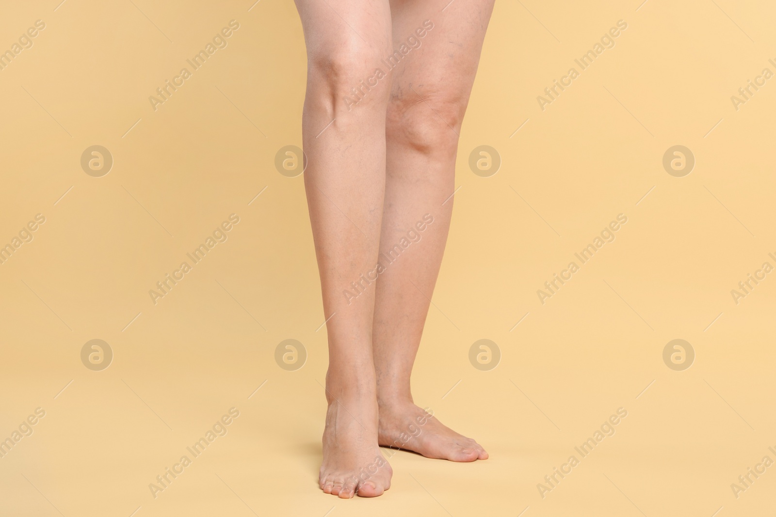 Photo of Closeup view of woman with varicose veins on yellow background