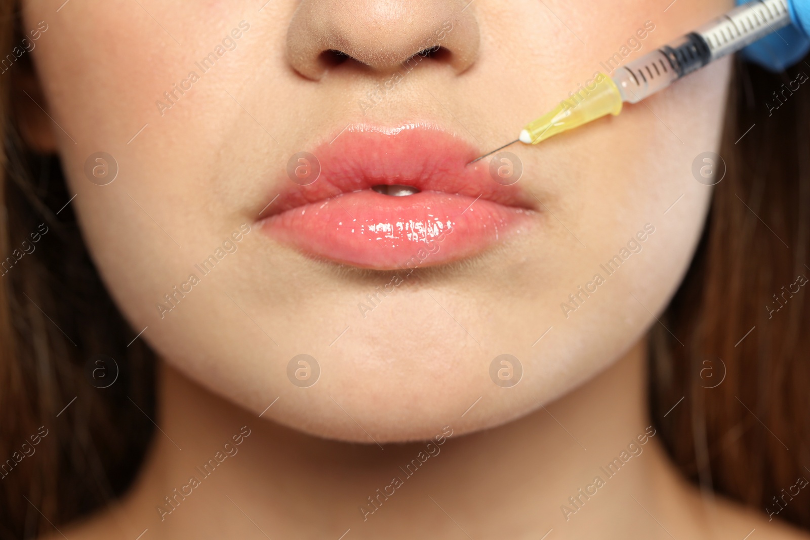 Photo of Young woman getting lips injection, closeup. Cosmetic surgery