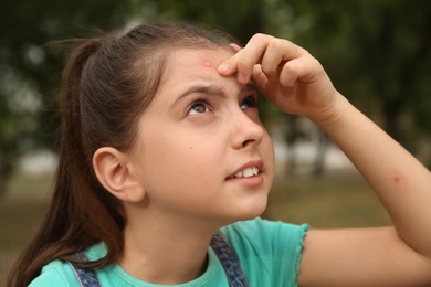 Photo of Girl scratching forehead with insect bite in park