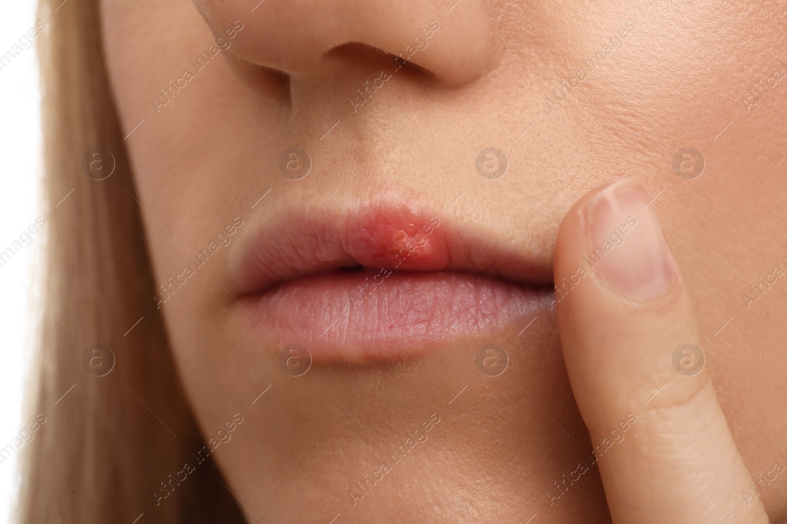 Photo of Woman suffering from herpes, closeup. Dermatological problem