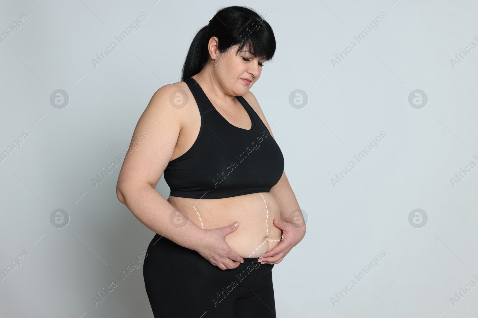 Photo of Obese woman with marks on body against light background, space for text. Weight loss surgery