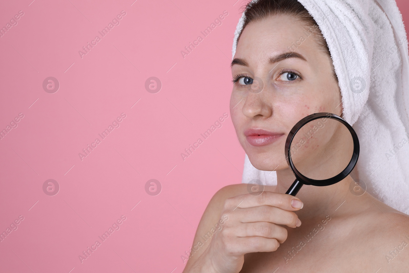 Photo of Young woman with acne problem holding magnifying glass near her skin on pink background. Space for text