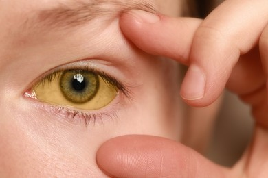 Photo of Woman with yellow eyes, closeup. Symptom of hepatitis