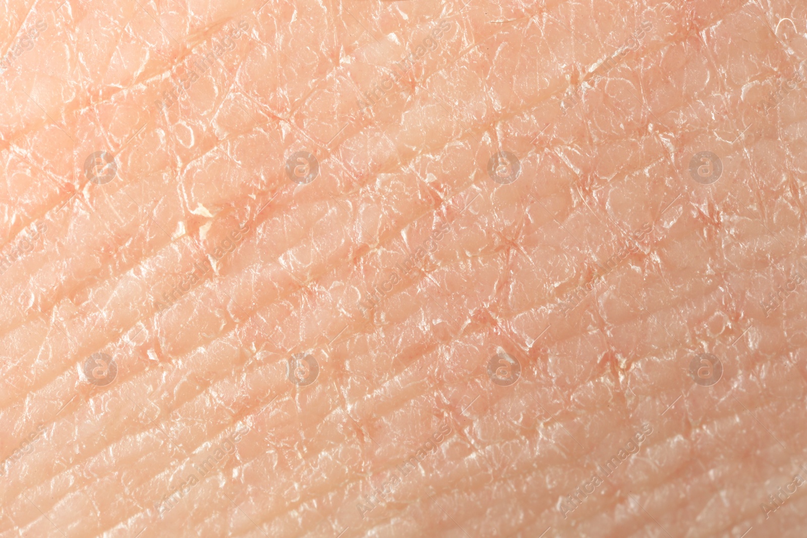 Photo of Texture of dry skin as background, macro view