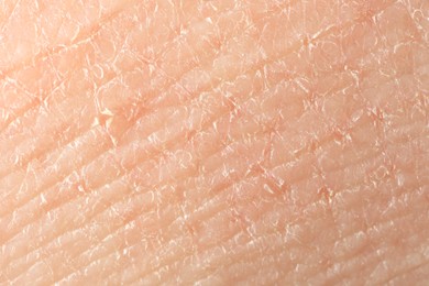 Photo of Texture of dry skin as background, macro view