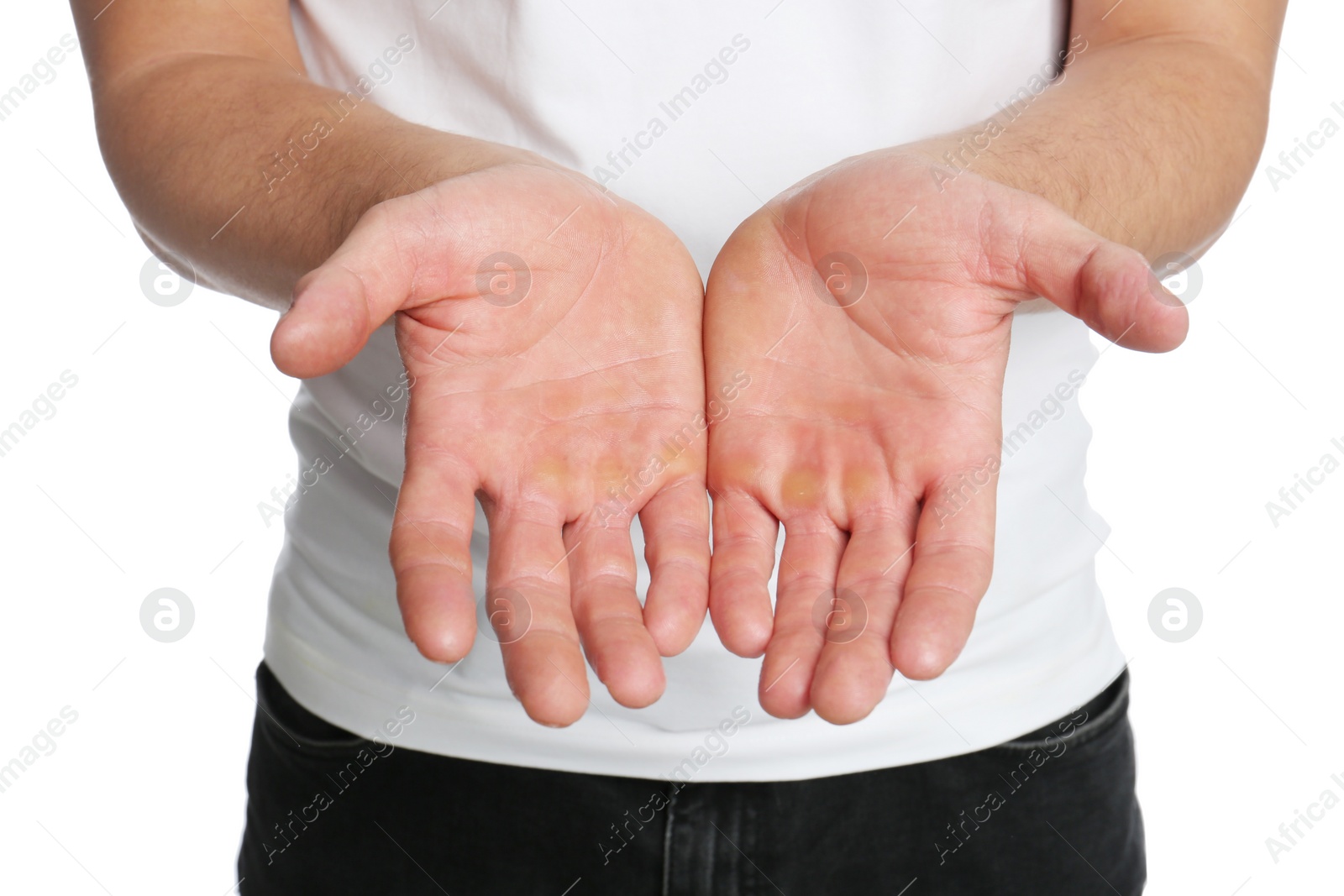 Photo of Man suffering from calluses on hands against white background, closeup