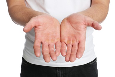 Photo of Man suffering from calluses on hands against white background, closeup