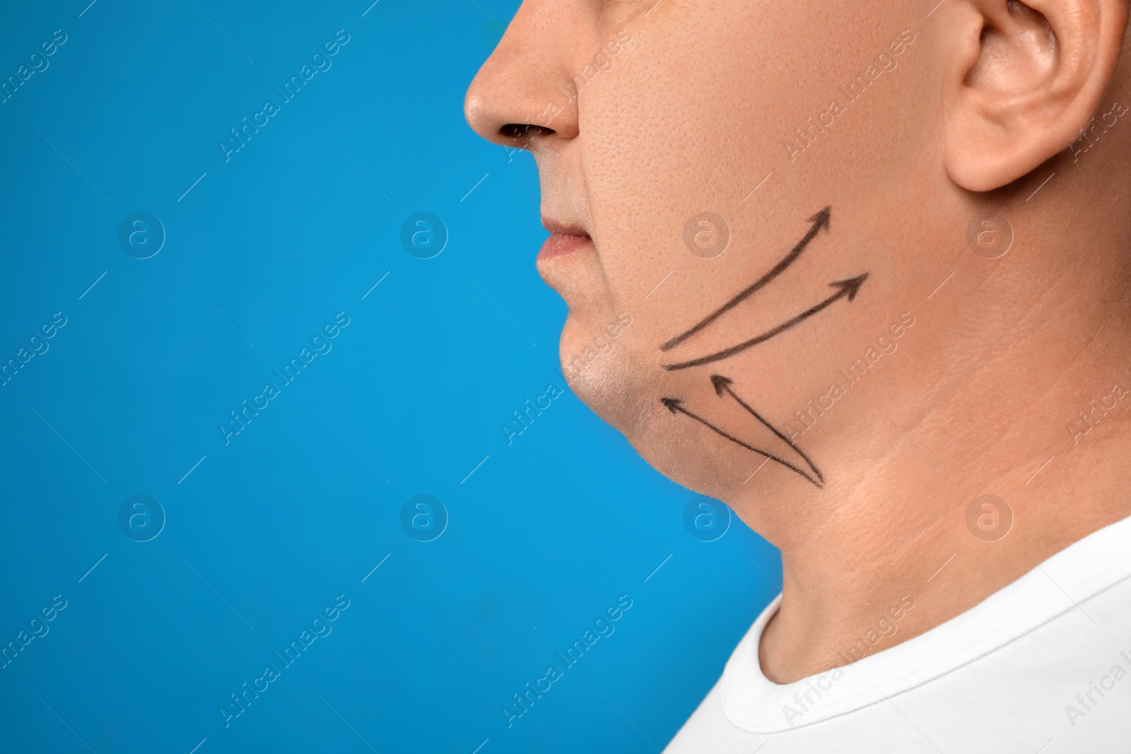 Photo of Mature man with marks on face against blue background, closeup. Double chin removal