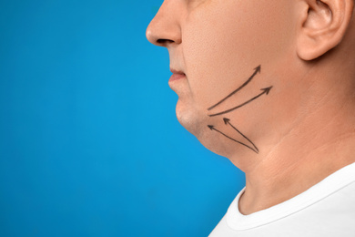 Mature man with marks on face against blue background, closeup. Double chin removal