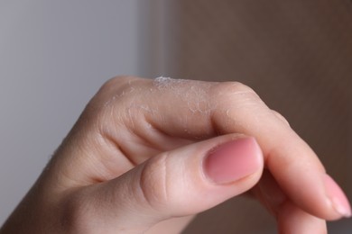 Photo of Woman with dry skin on hand against blurred background, macro view