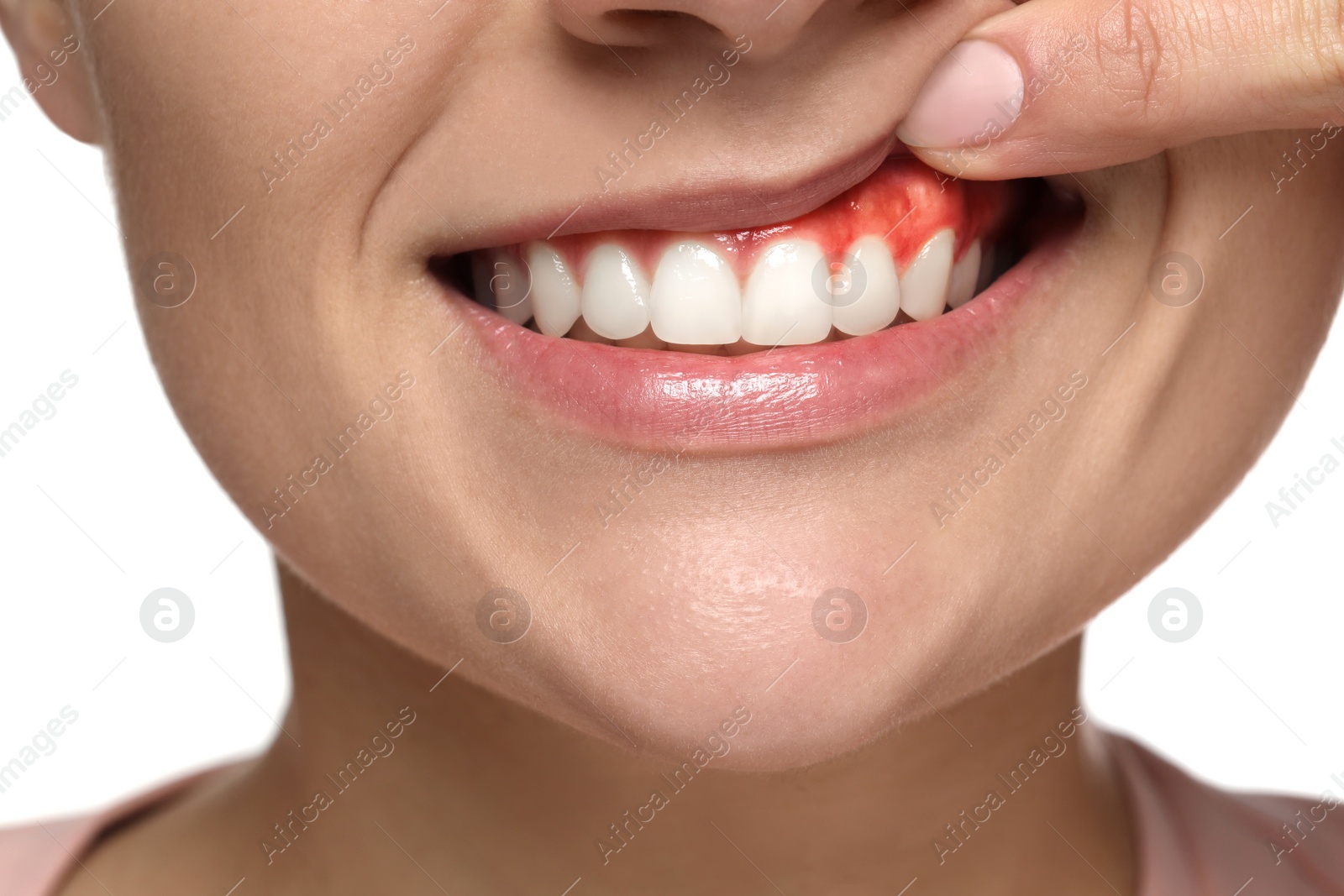 Image of Woman showing inflamed gum on white background, closeup