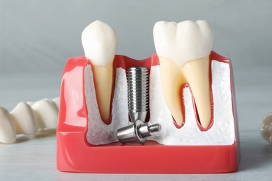 Photo of Educational model of gum with post for dental implant between teeth and crowns on white wooden table, closeup