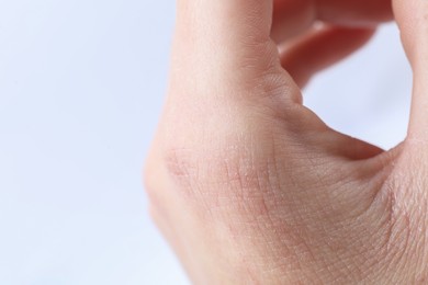 Photo of Woman with dry skin on hand against light background, closeup. Space for text