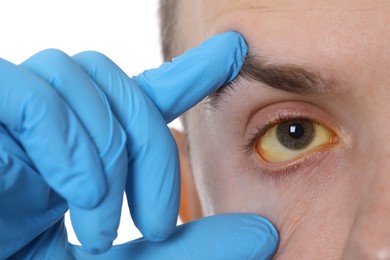 Photo of Man checking his health condition on white background, closeup. Yellow eyes as symptom of hepatitis