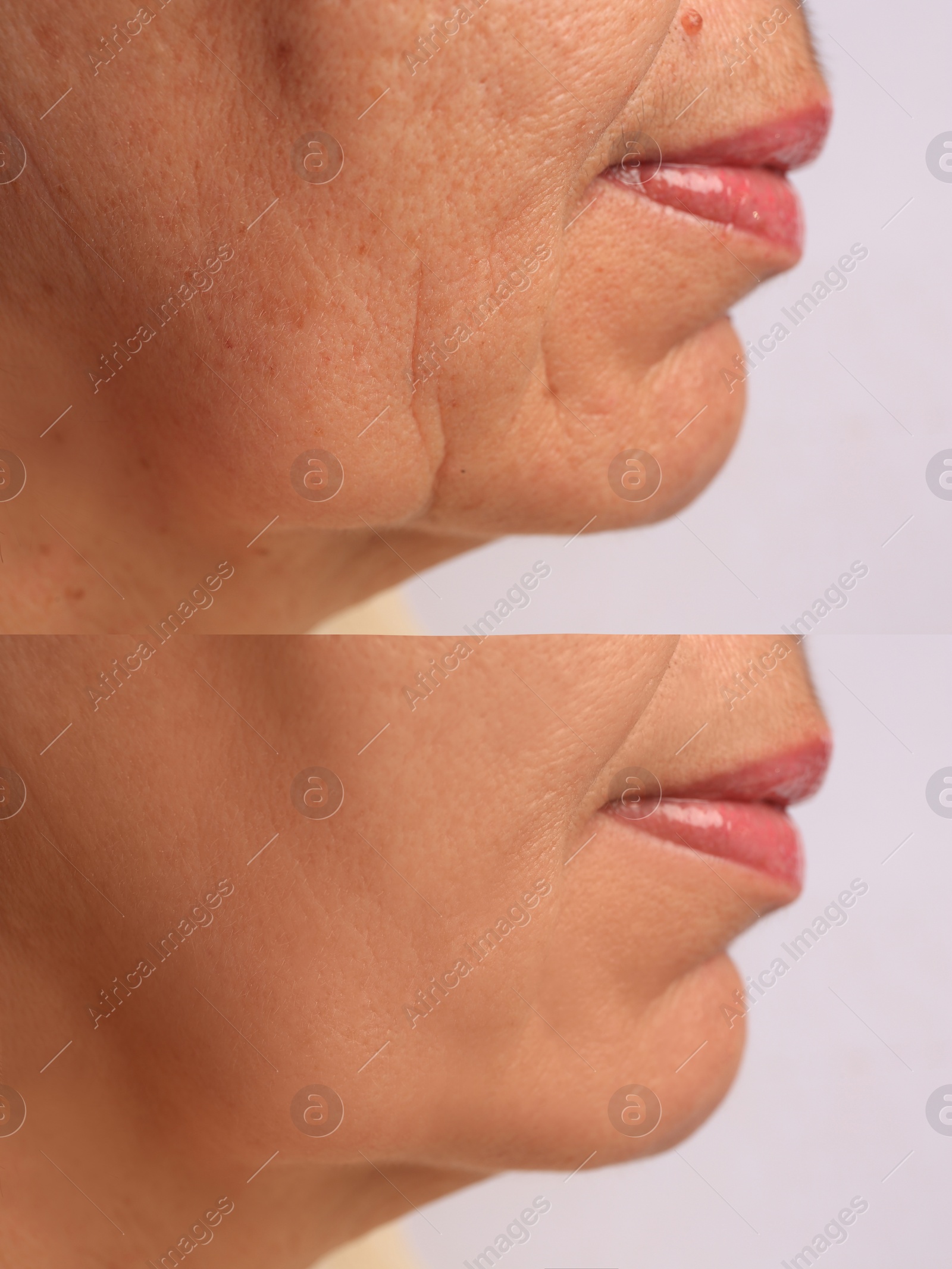 Image of Woman before and after rejuvenating procedures. Collage with photos on white background, closeup