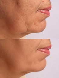 Woman before and after rejuvenating procedures. Collage with photos on white background, closeup
