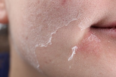 Photo of Woman with dry skin on face, closeup