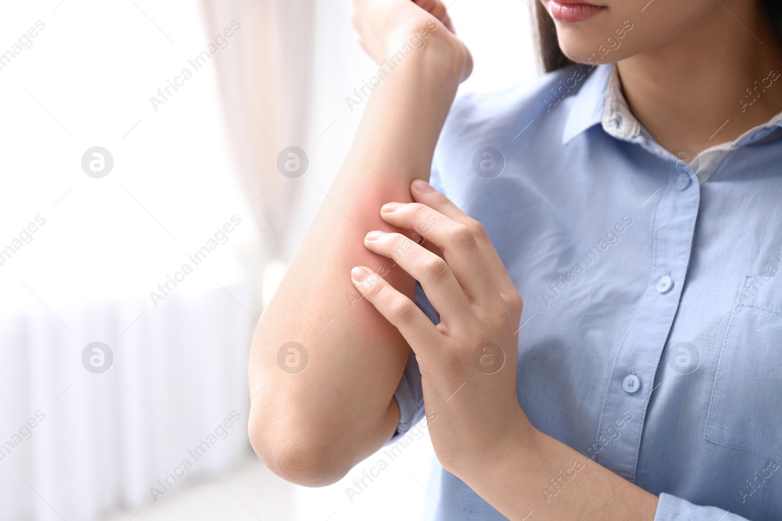 Photo of Young woman scratching hand indoors, closeup with space for text. Allergies symptoms