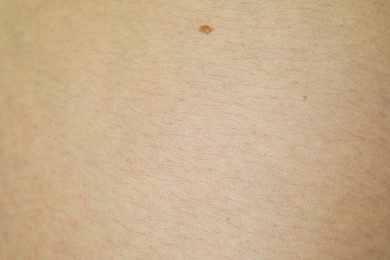 Texture of human skin with birthmark as background, closeup view