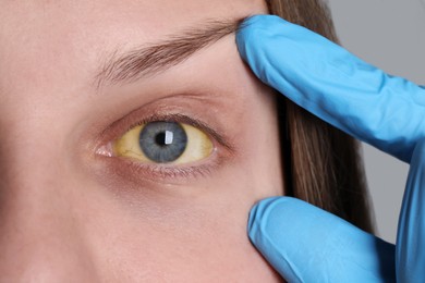 Doctor checking woman with yellow eyes on light background, closeup. Symptom of hepatitis