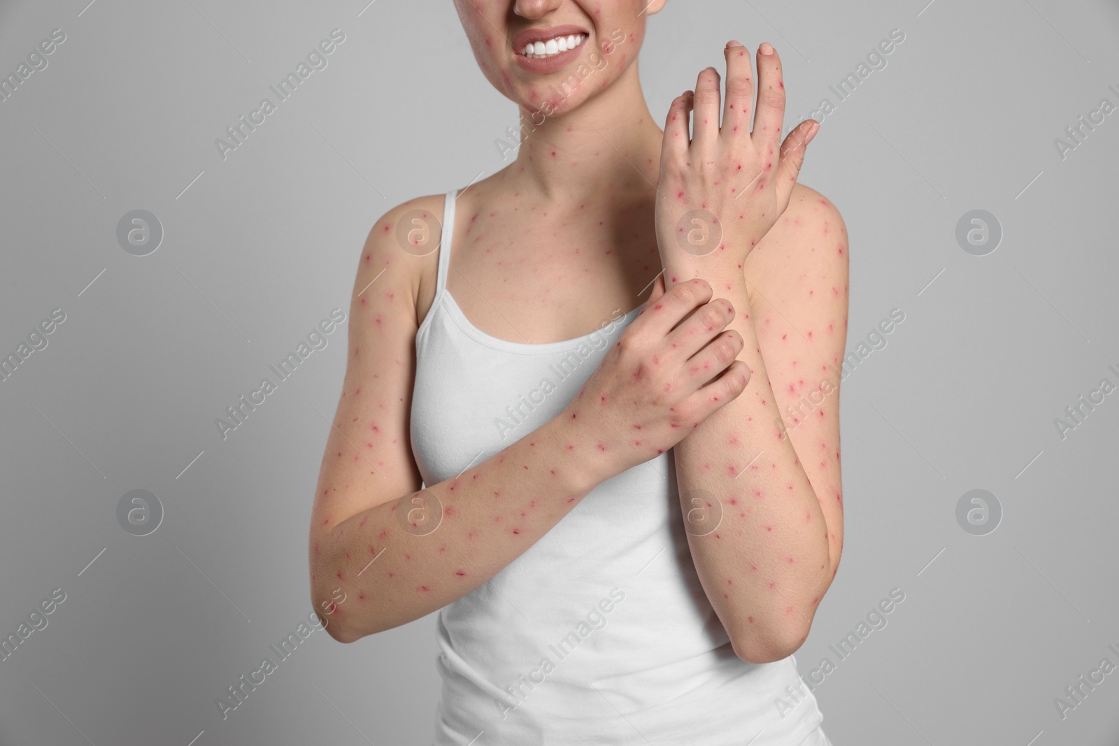 Photo of Woman with rash suffering from monkeypox virus on light grey background, closeup